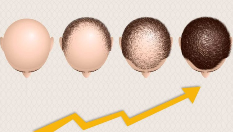 Factors Affecting Hair Transplant Results