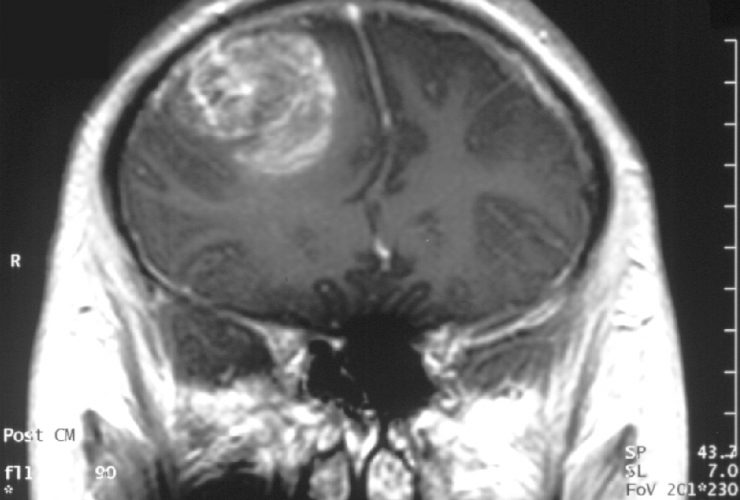glioblastoma